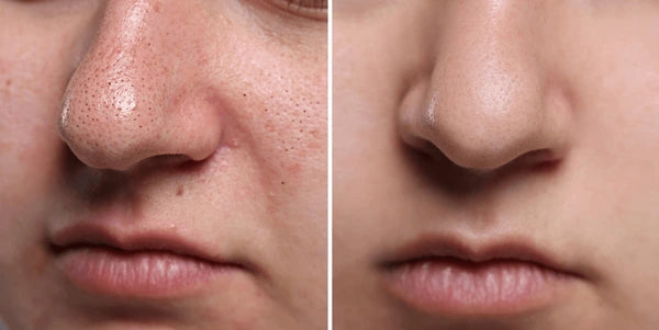 Blackhead Remover Vacuum