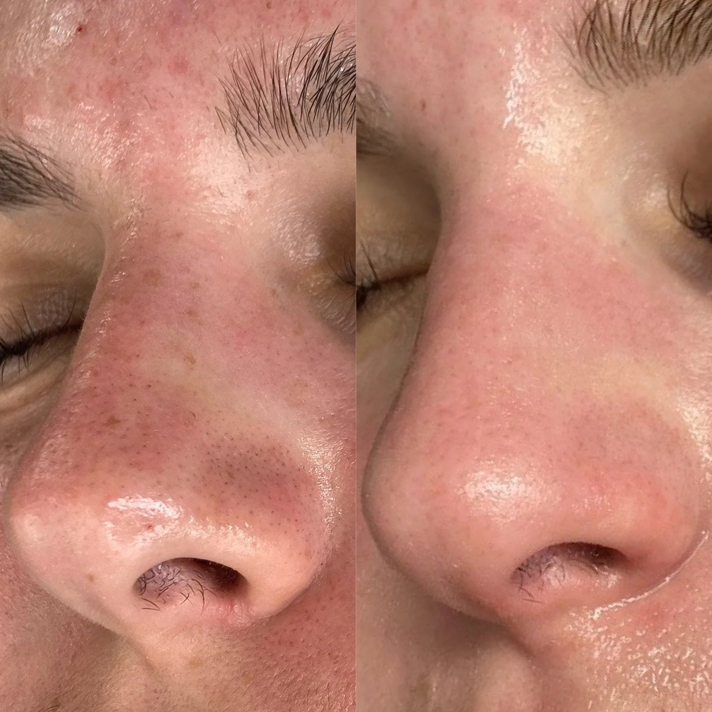Blackhead Remover Vacuum