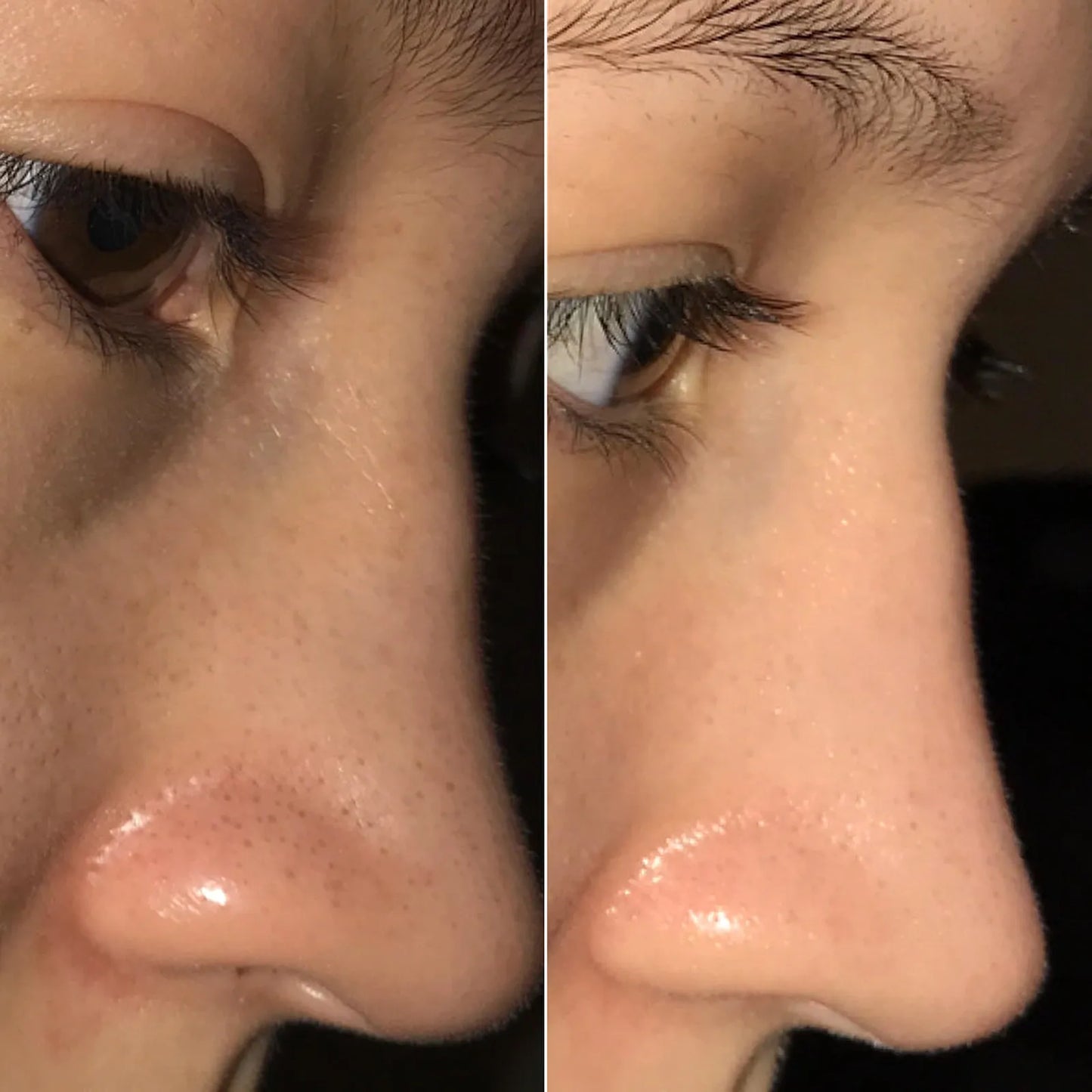 Blackhead Remover Vacuum