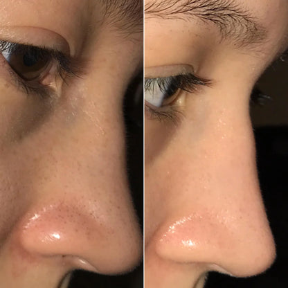 Blackhead Remover Vacuum